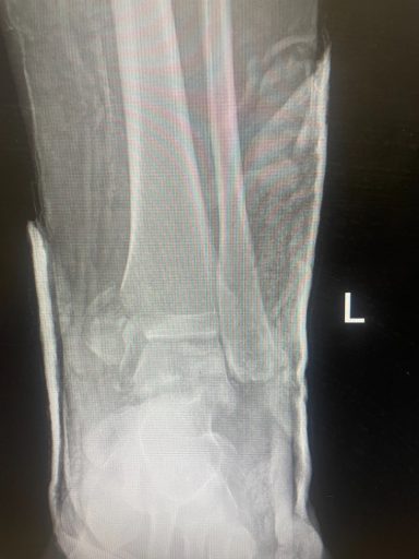 Unstable ankle fracture before fixation (AP)