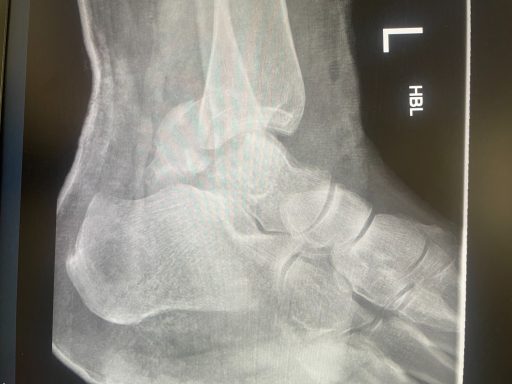 Same injury, lateral view