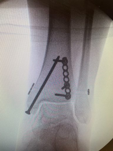 Medial malleolus fixed with plate and screws