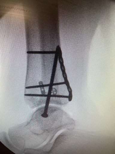 Lateral view after fixation