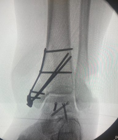 Bimalleolar fixation