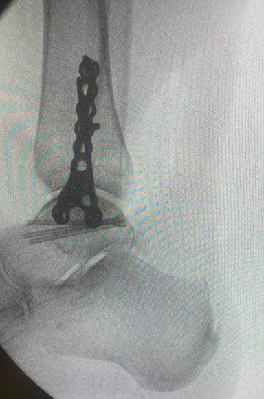 Anterior distal tibial plate