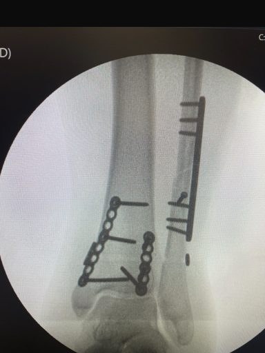 Fibular and medial fixation, intra-operative