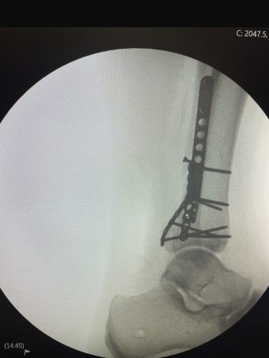 Lateral intra-operative image