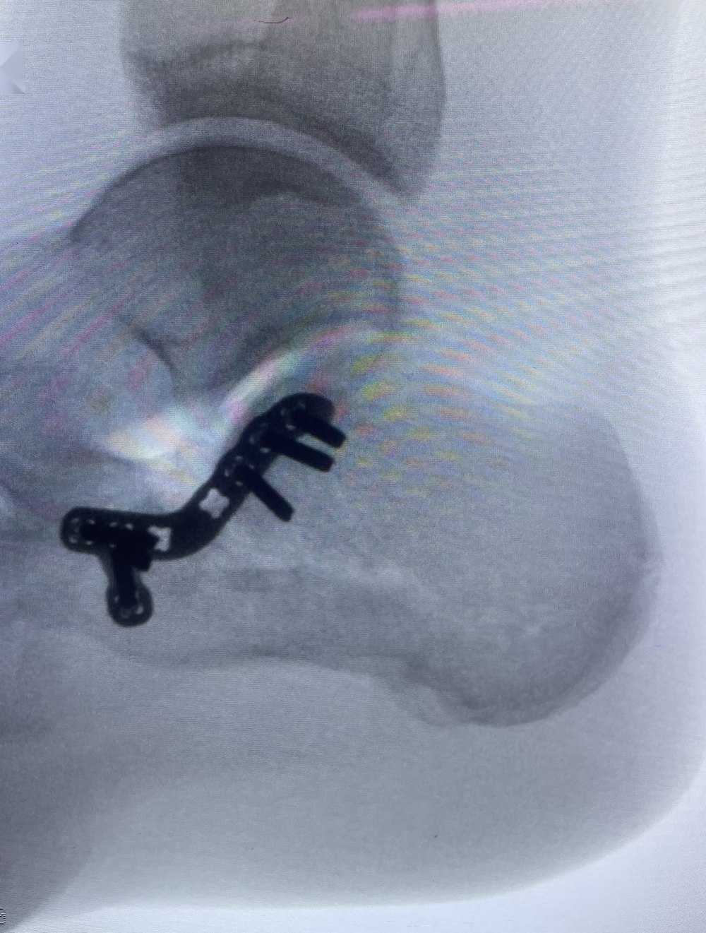 Calcaneal fracture X-ray