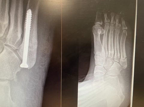 Jones fracture X-ray