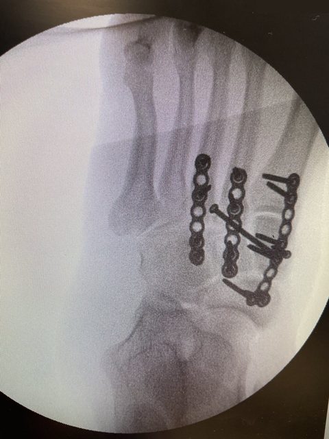 Lisfranc injury X-ray