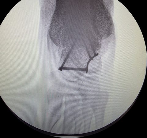 Talus fracture X-ray