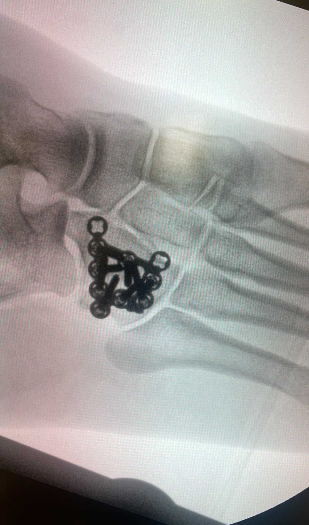 Cuboid fracture X-ray