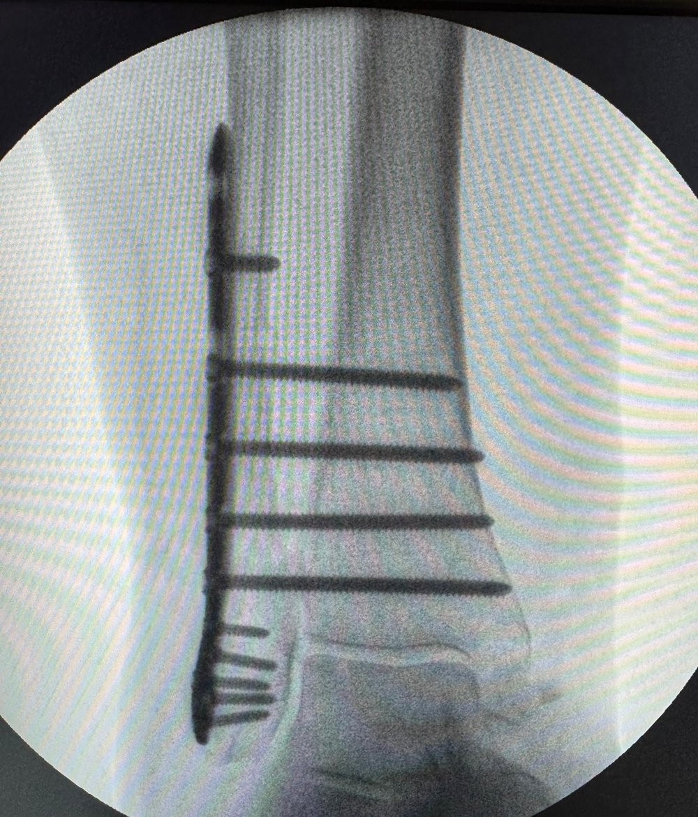 Ankle fracture in diabetes X-ray