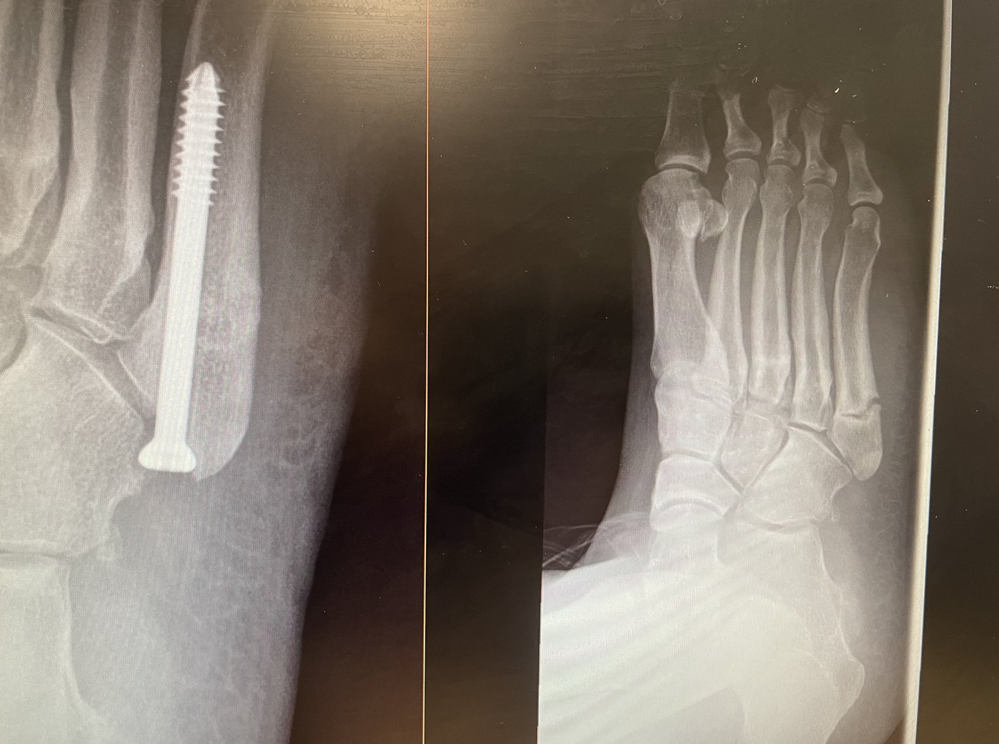 Jones fracture X-ray