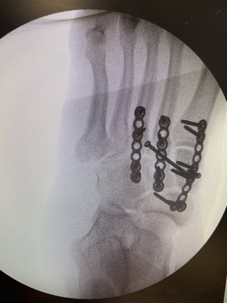 Lisfranc injury held with dorsal bridge plates (AP)
