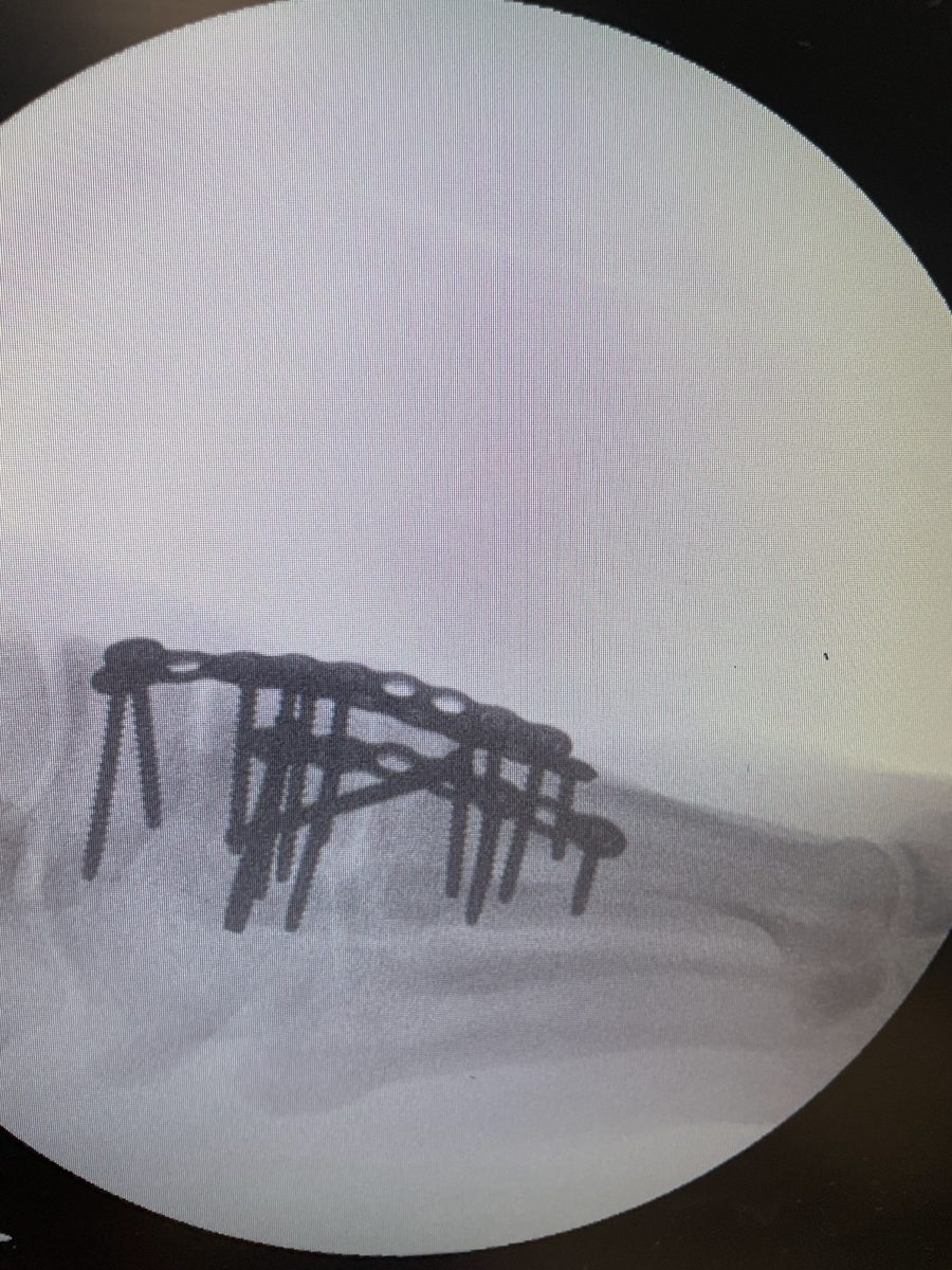 Lateral view of the bridge-plate construct