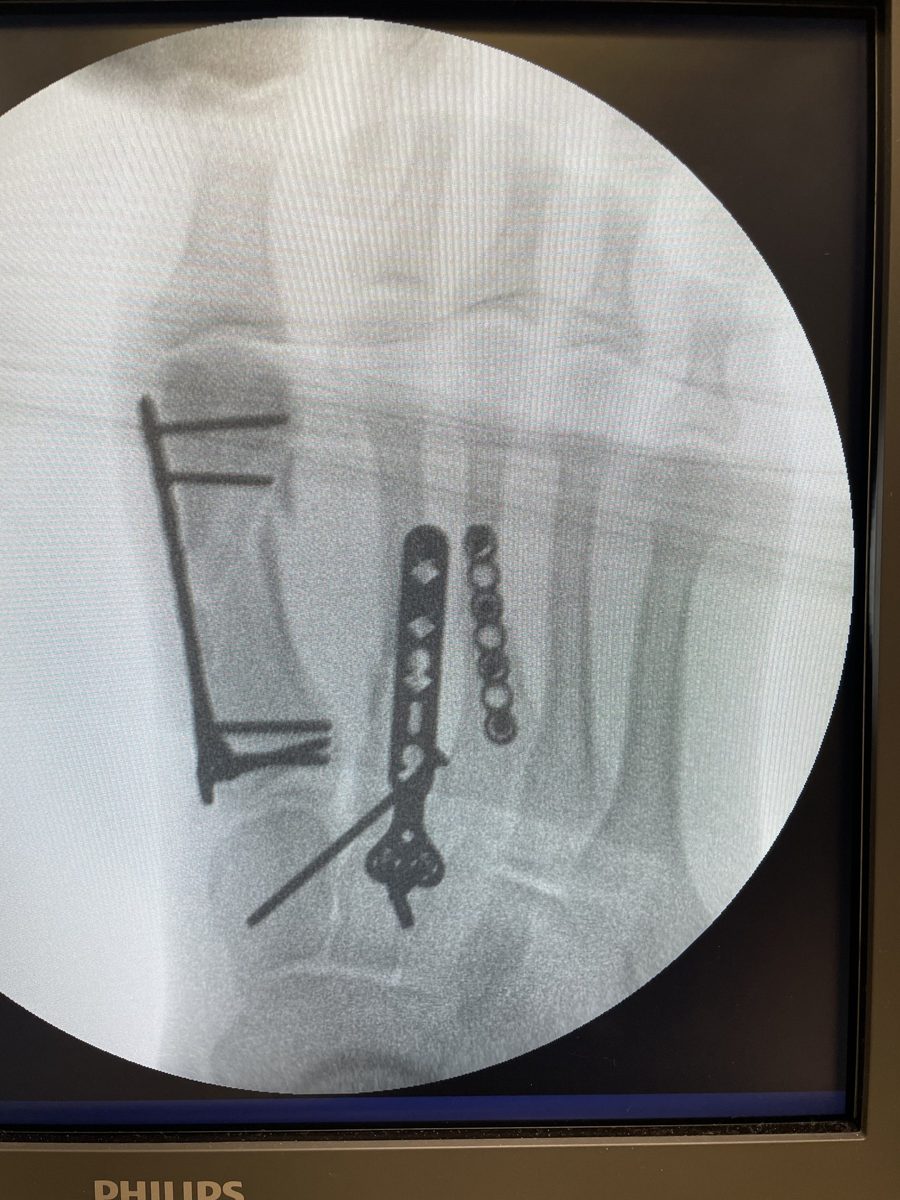 Multiple metatarsal fractures fixed with low-profile plates (AP)
