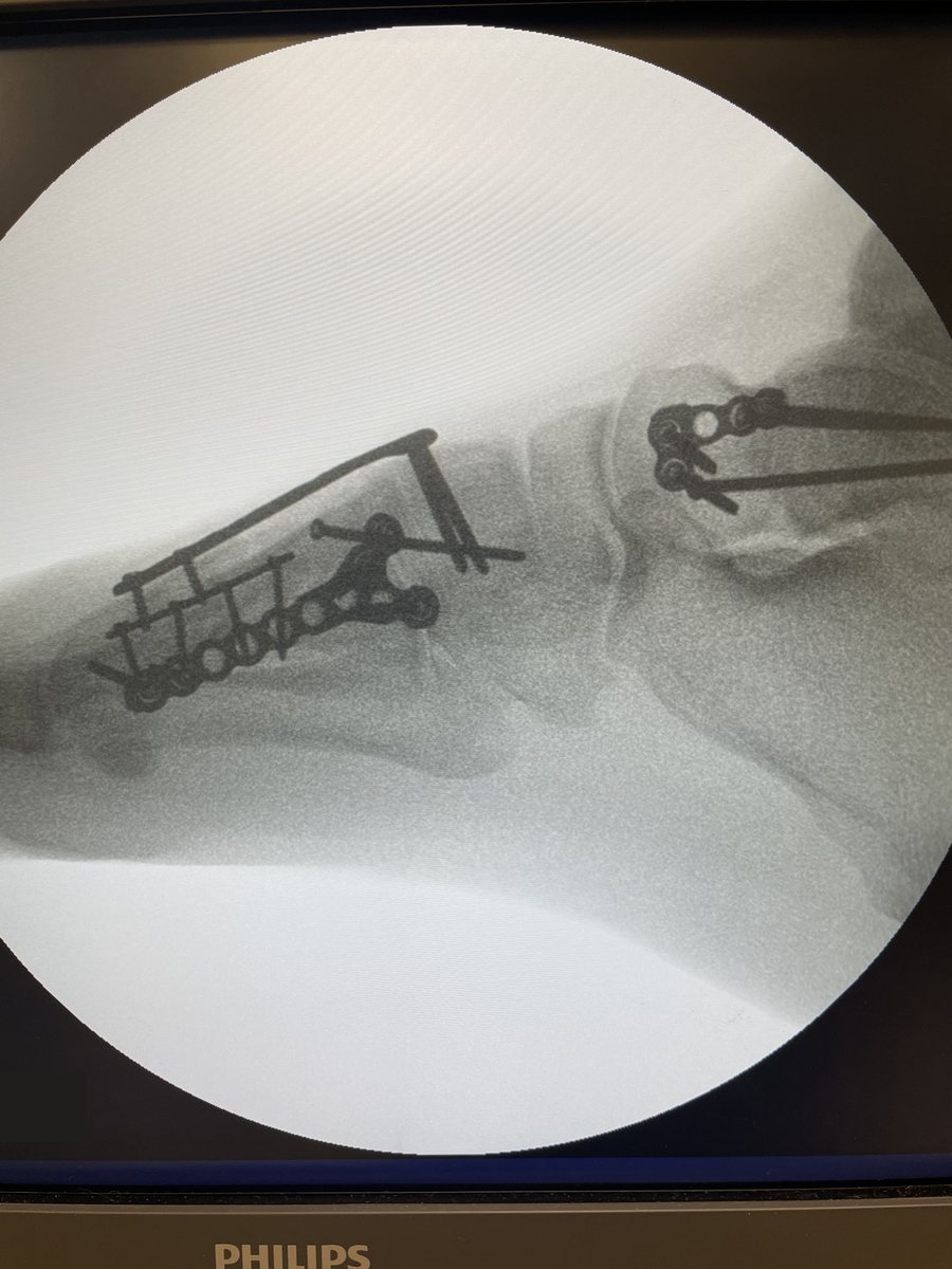 Lateral view after fixation