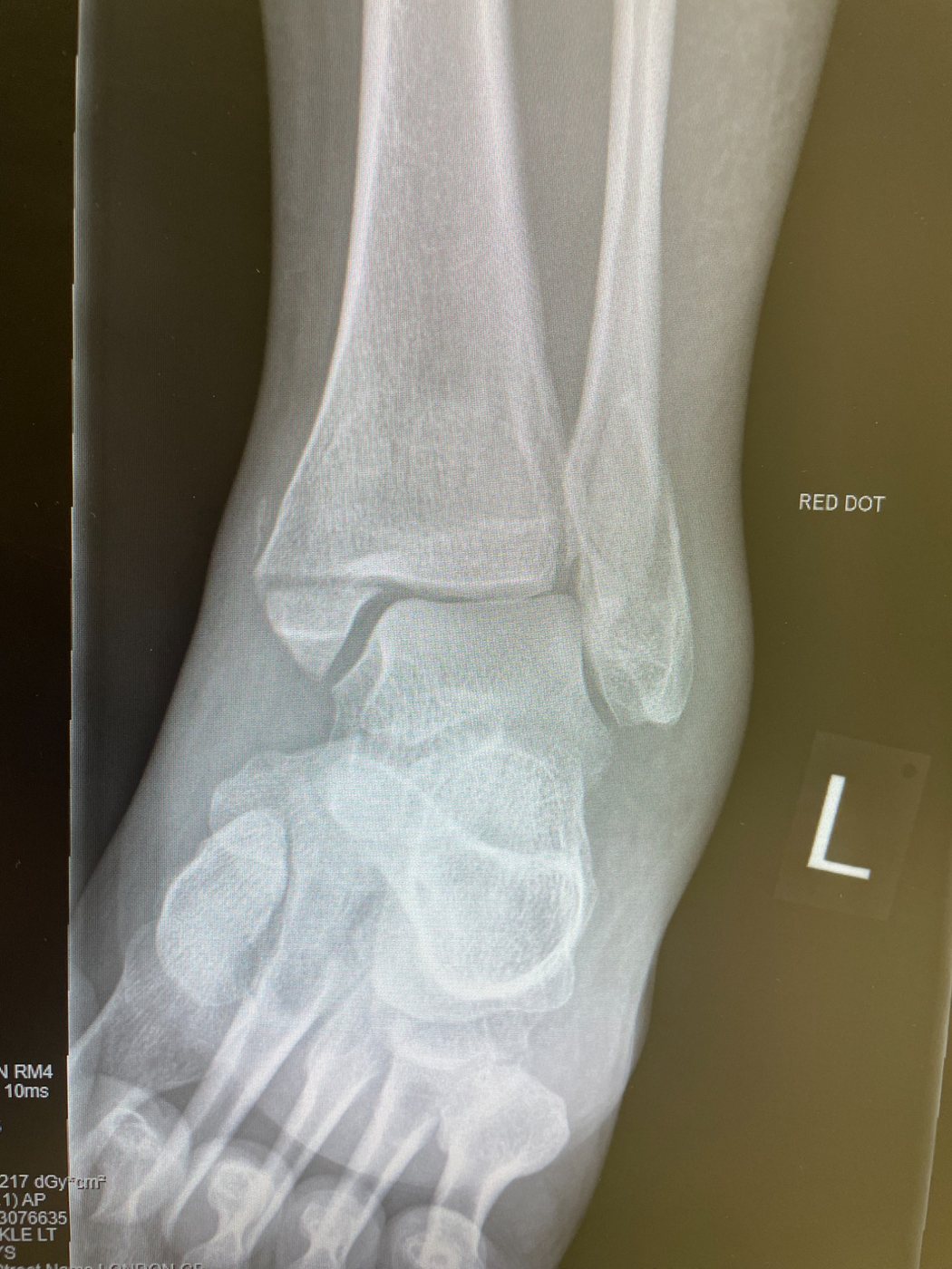Ankle X-ray, AP view
