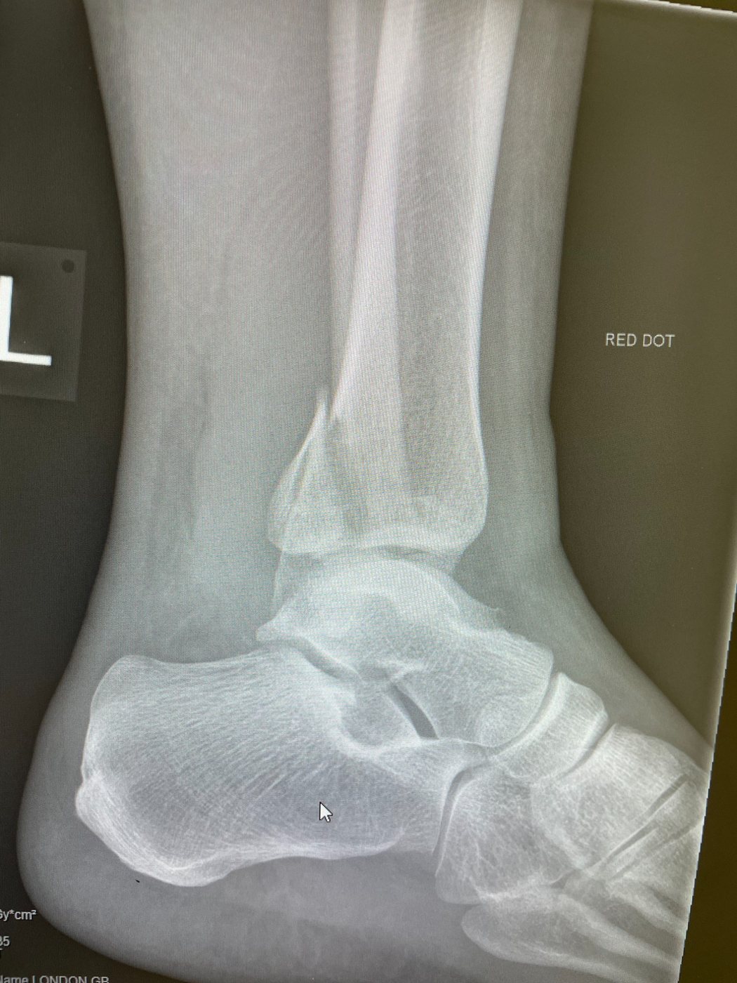 Ankle X-ray, lateral view