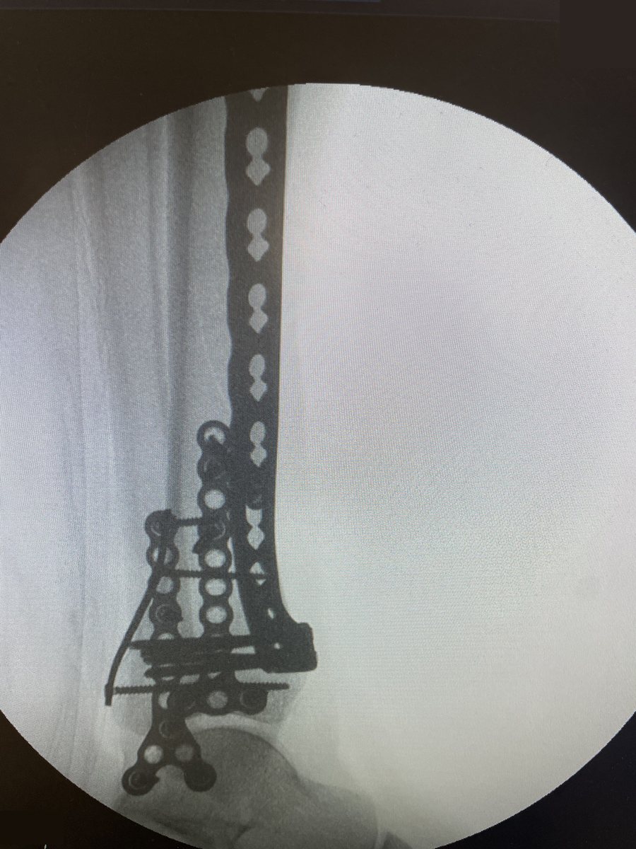 Pilon fracture reconstructed with anterolateral, medial and fibular plates
