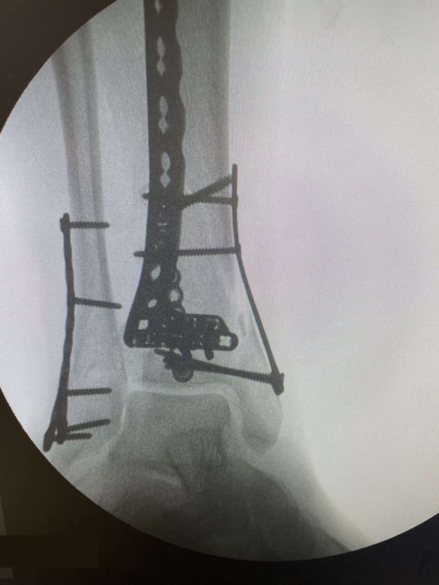 Joint surface restored and held with plates and screws