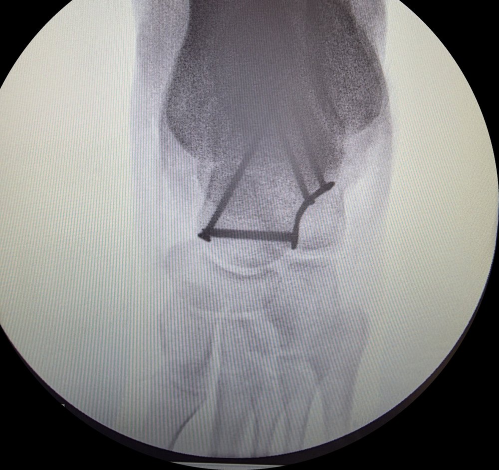 Talus fracture fixed with screws (AP view)