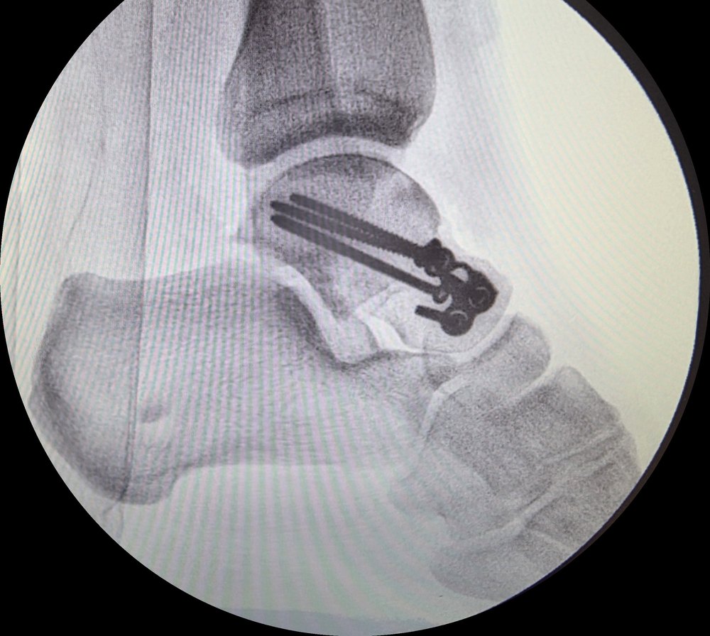 Lateral view showing screw fixation of the talus